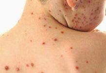 Morbillo, l’allarme dell’infettivologo: “Casi in crescita, ricoveri frequenti negli adulti”
