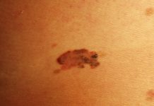 Melanoma, l’ultima scoperta sulle cellule che si “nascondono”